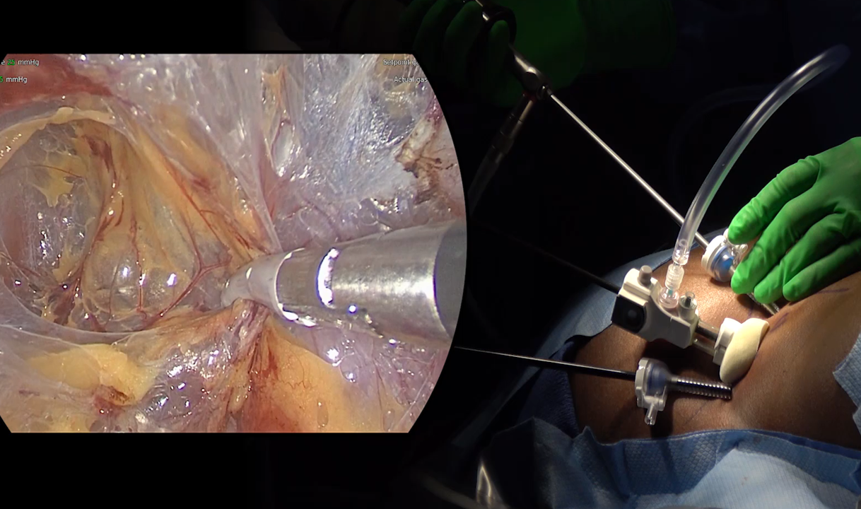 The Mini Back Scope Adrenalectomy (MBSA) is performed with a fiberoptic camera and fine endoscopic instruments