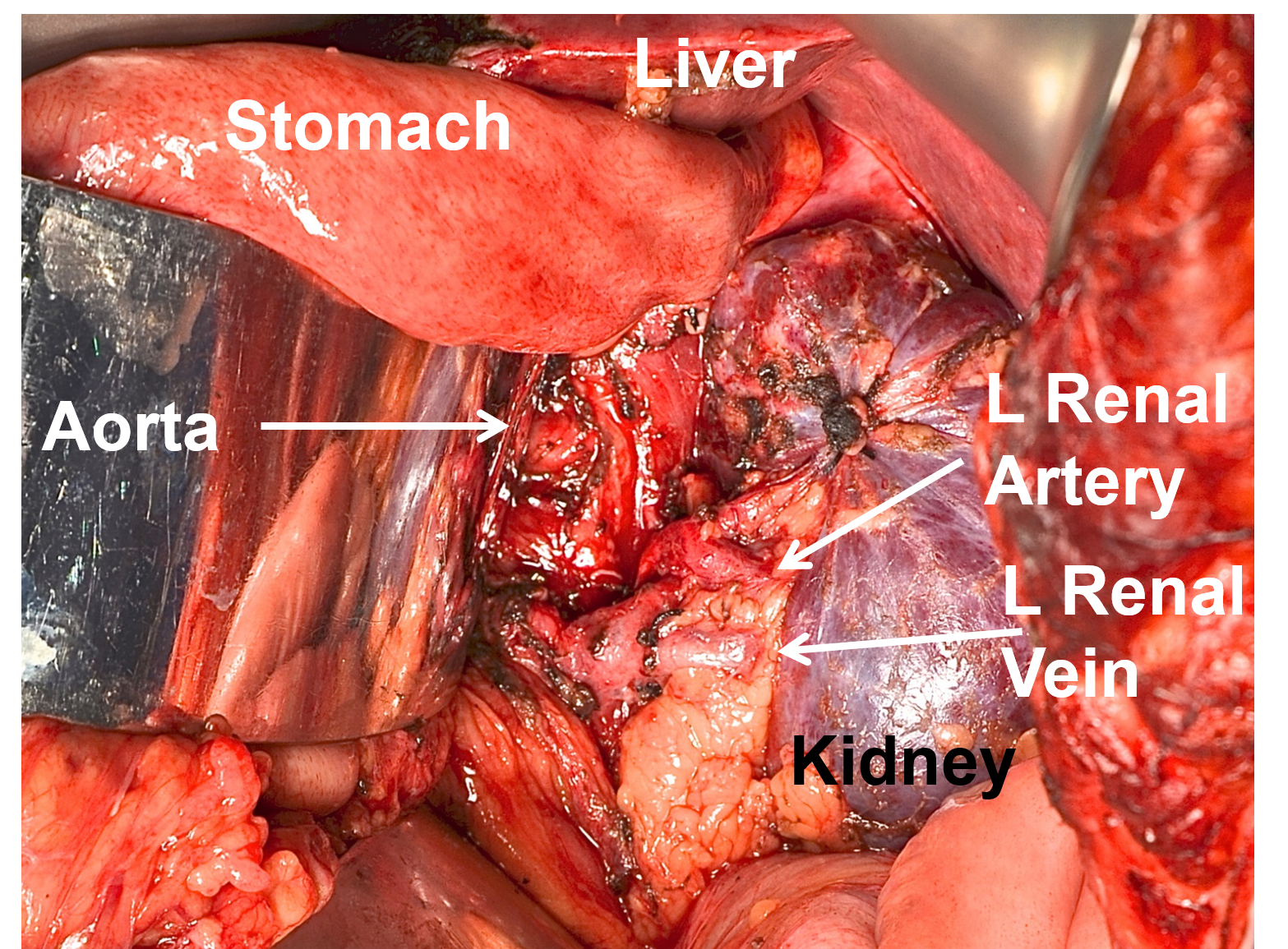 Completed resection after an open, old-fashioned reoperation for pheochromocytoma tumor spilled throughout the abdomen (called “pheochromocytomatosis”) at the initial operation 15 years prior at an outside institution.