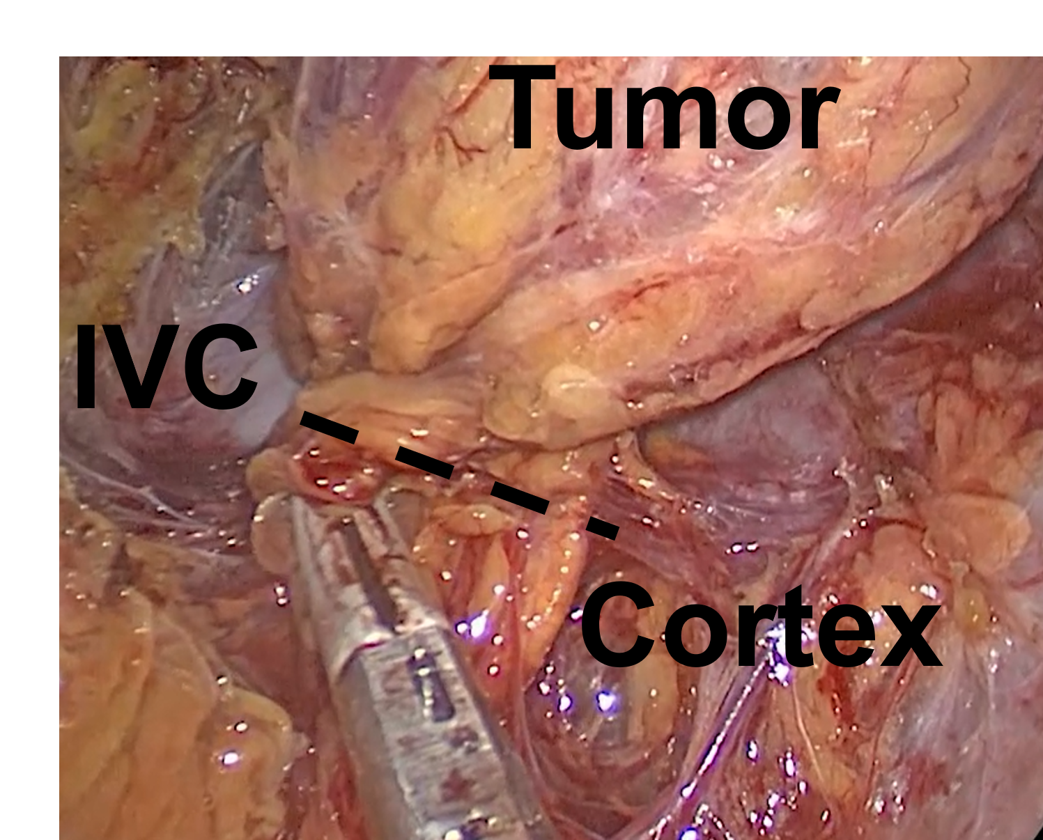 Partial Cortical-Sparing Adrenalectomy Performed via Right Mini Back Scope Adrenalectomy (MBSA). The tumor specimen is divided at the dotted line, removing the tumor, but preserving the normal cortex and the inferior vena cava (IVC).
