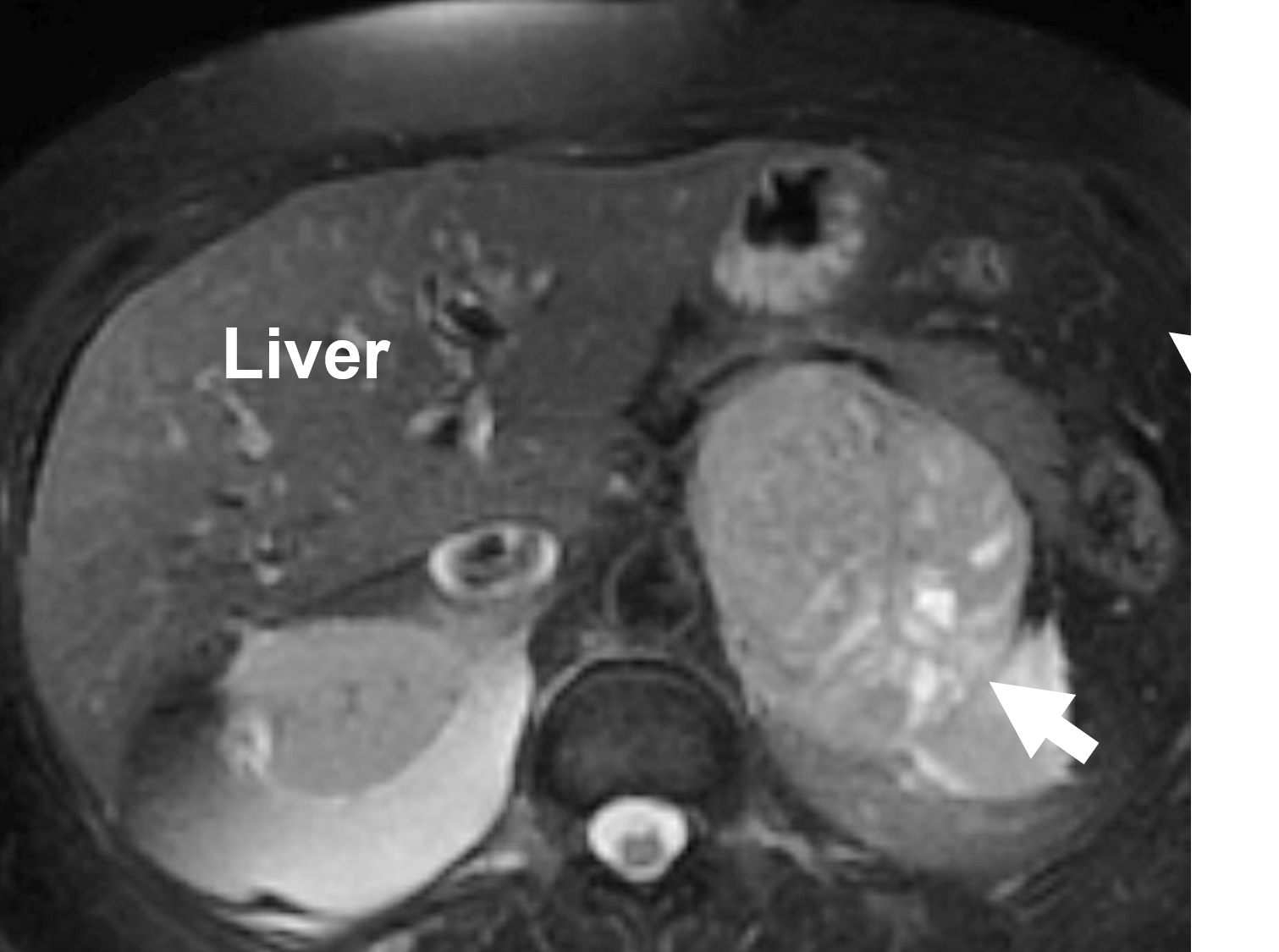 The large adrenal gland cancer (13.5 cm; arrow) is shown sitting on top of the left kidney