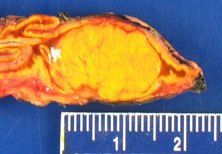 A typical functional adrenal tumor producing excess aldosterone causing Conn's Syndrome.