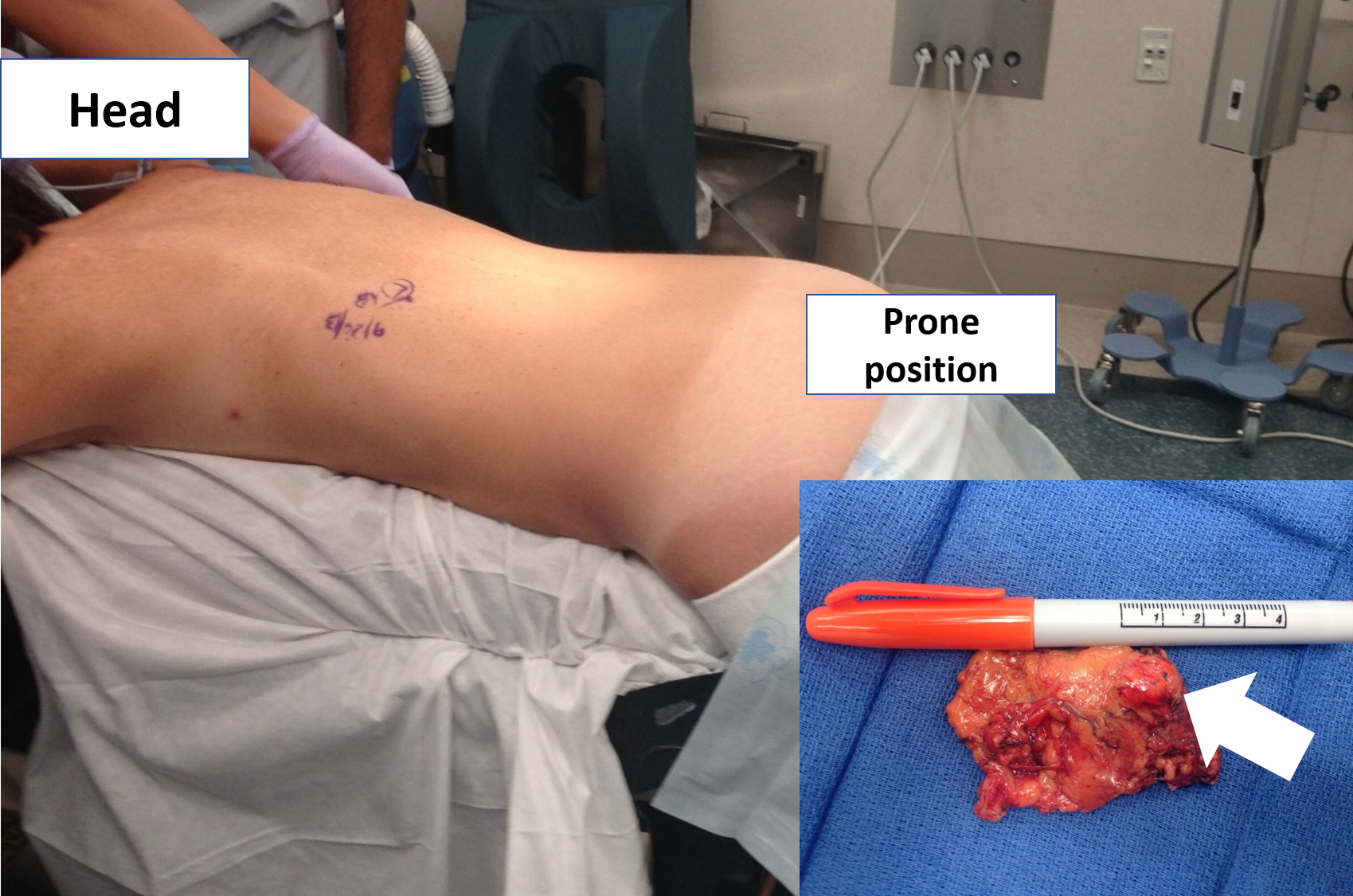 The correct prone position of a patient undergoing a left Mini Back Scope Adrenalectomy (MBSA).