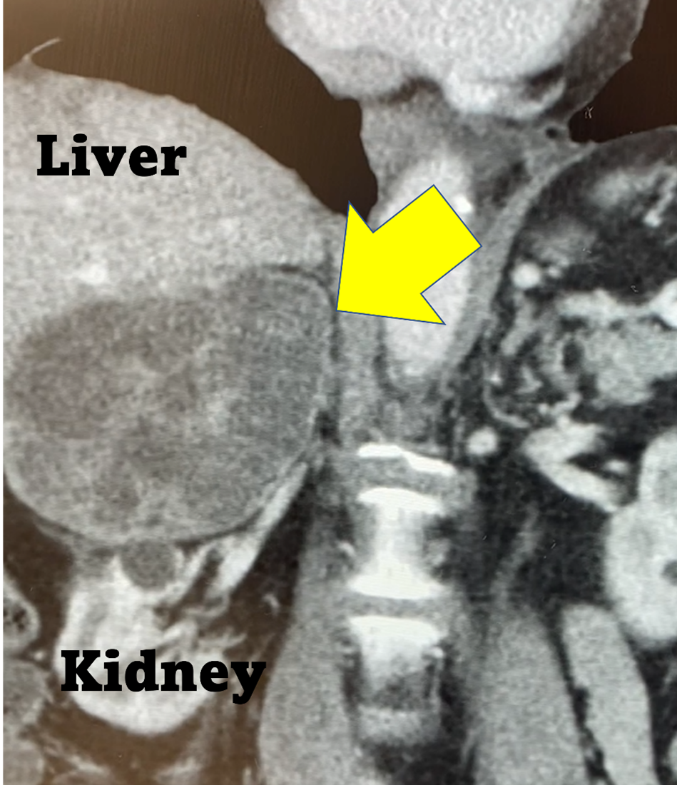 Huge 15 cm right pheochromocytoma on a CT scan. This pheochromocytoma is better removed using the Laparoscopic Hand-port Assisted Trans-Abdominal Adrenalectomy.