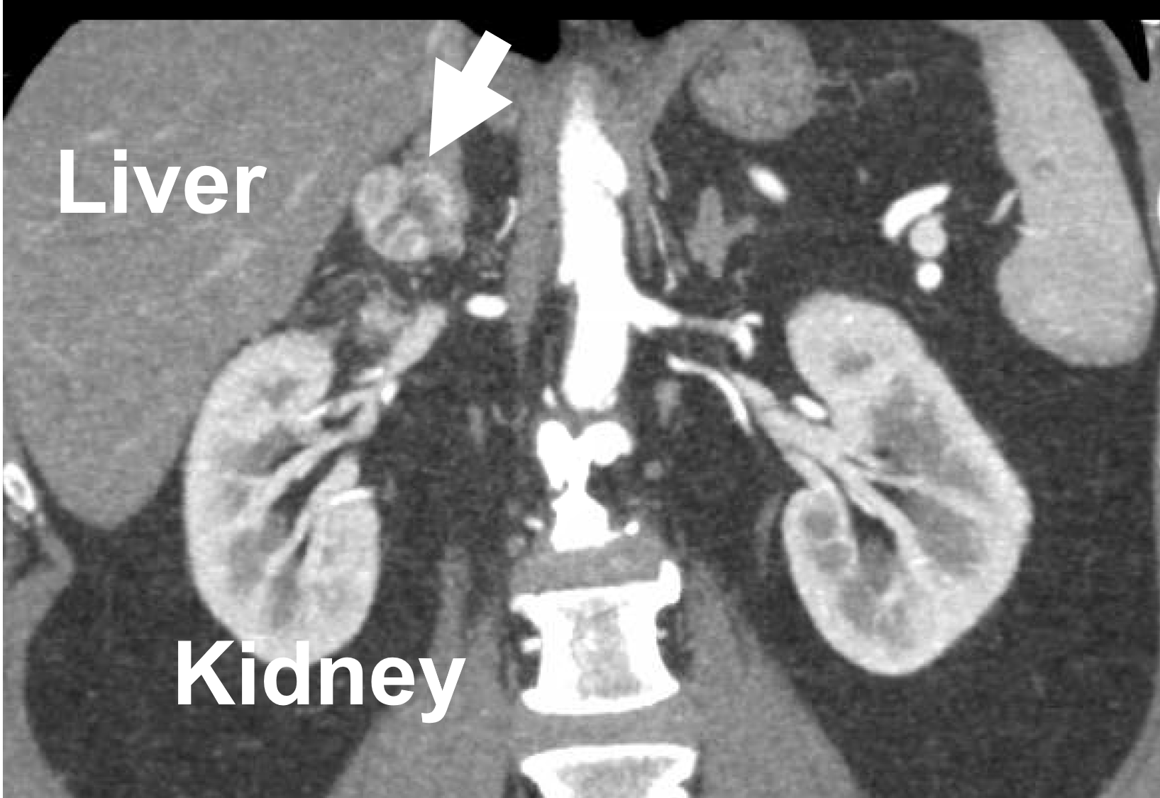 kidney adrenal gland cancer