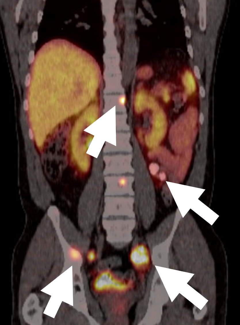 Een 68 DOTATATE PET/CT-scan voor kwaadaardig feochromocytoom waarop meerdere metastatische laesies in bot en lymfeklieren (pijlen) te zien zijn.