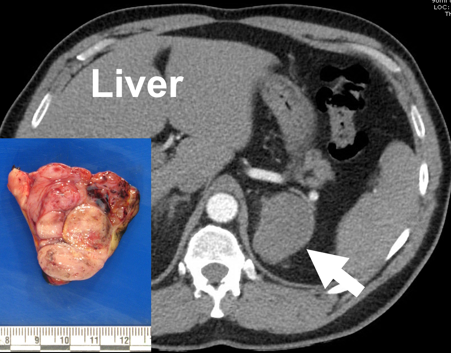 En venstre adrenokortikal cancer (pil) afbildet på en kontrastforstærket CT med binyrebarkprotokol (arteriel fase) og efter fjernelse. 