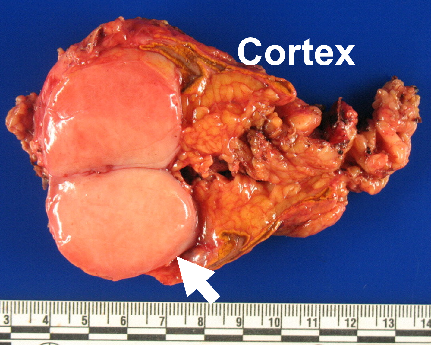 symptoms of adrenal gland tumor