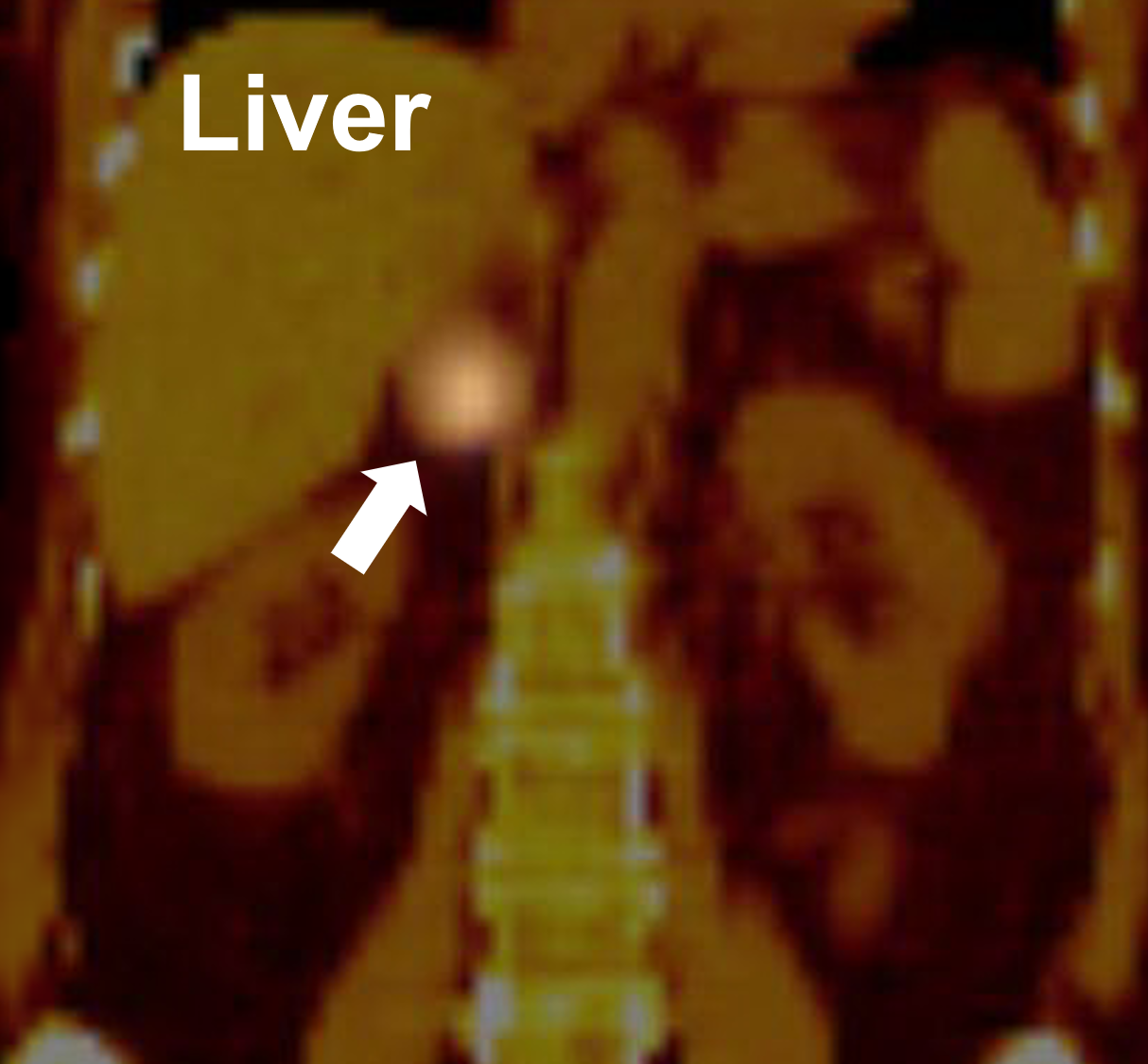 Una scansione MIBG che dimostra un assorbimento positivo nella ghiandola surrenale destra (freccia) che dimostra essere un feocromocitoma.