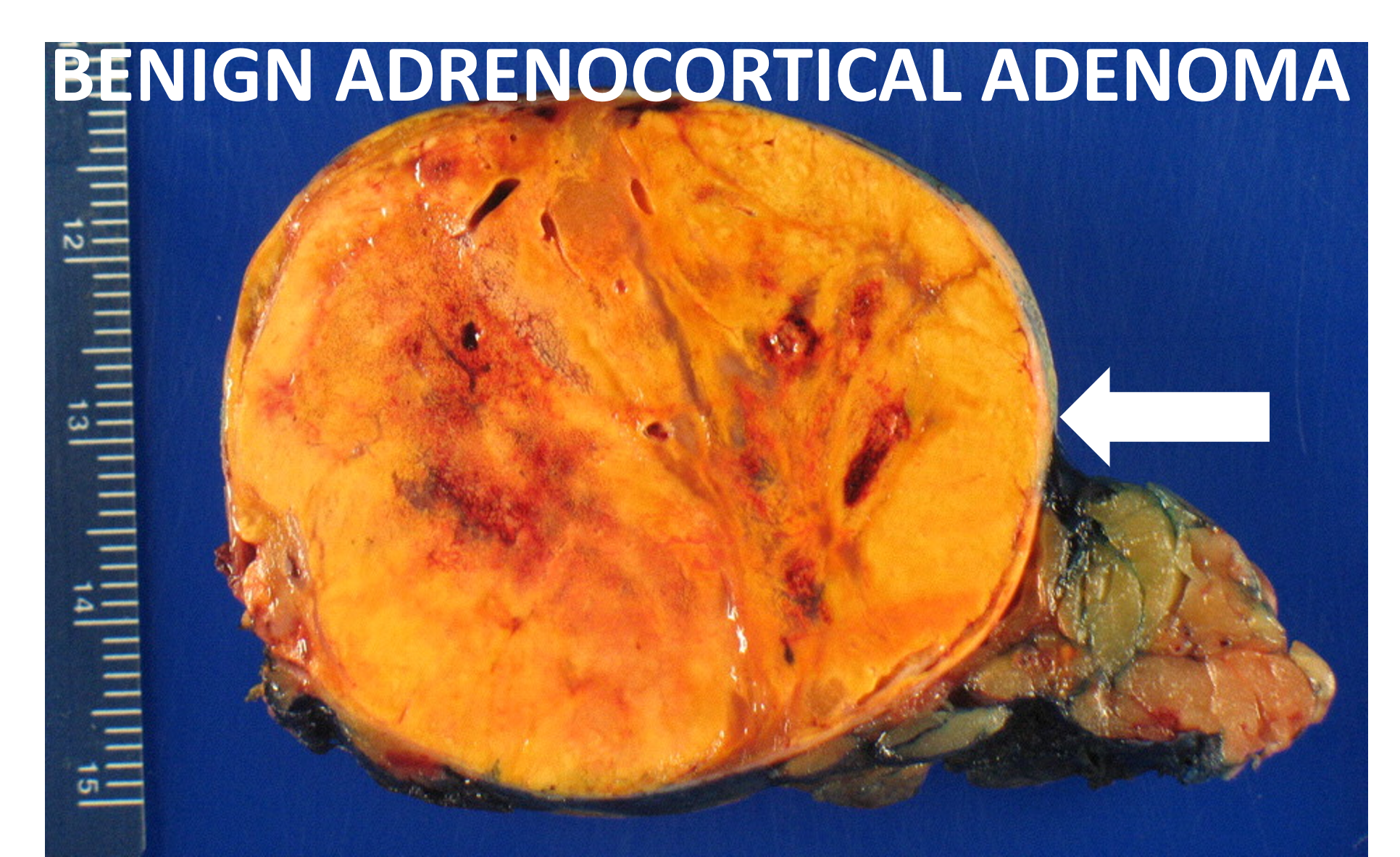 adrenal gland symptoms