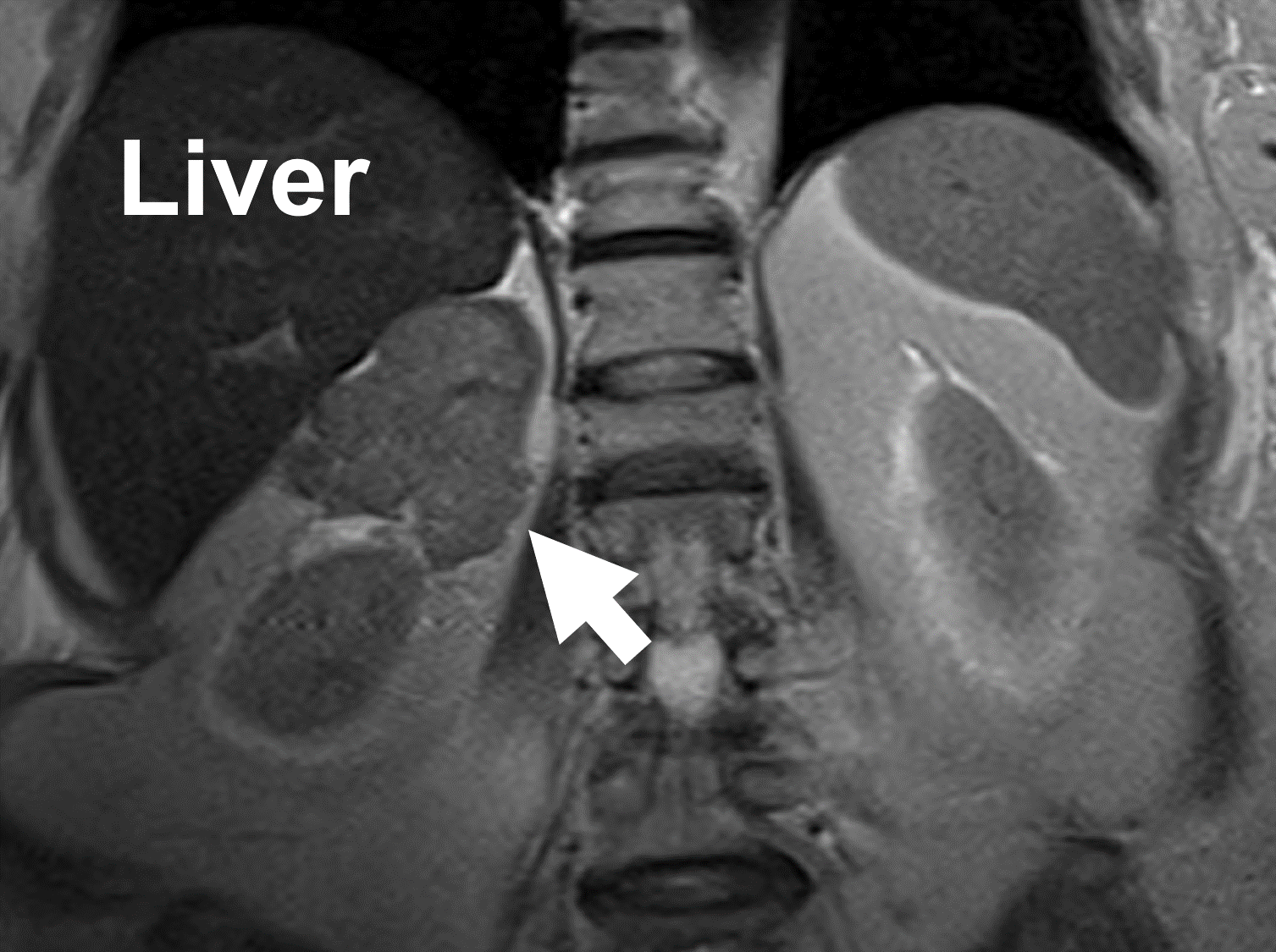 Radiografía que muestra un cáncer suprarrenal (flecha) que surge de la glándula suprarrenal derecha. Nótese la heterogeneidad y los bordes irregulares.